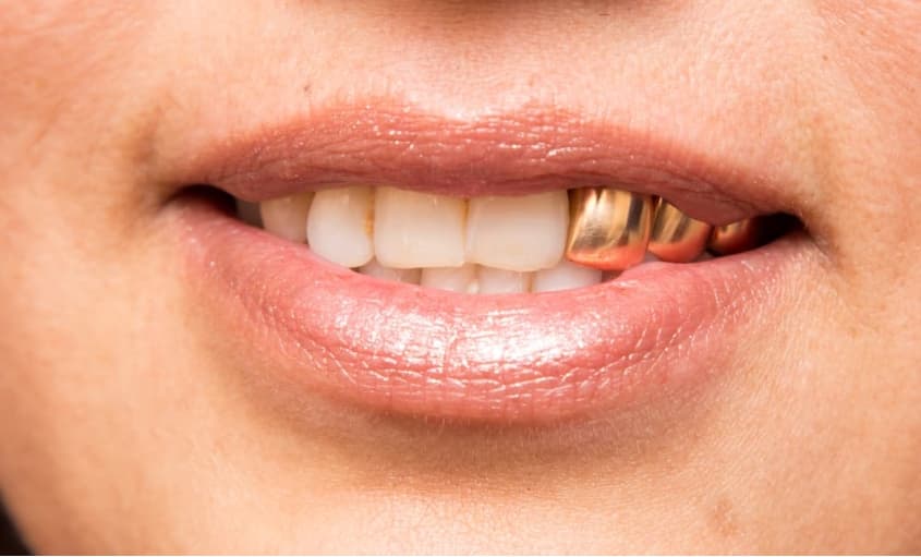 دندان-طلا-آرتمیس-گلد